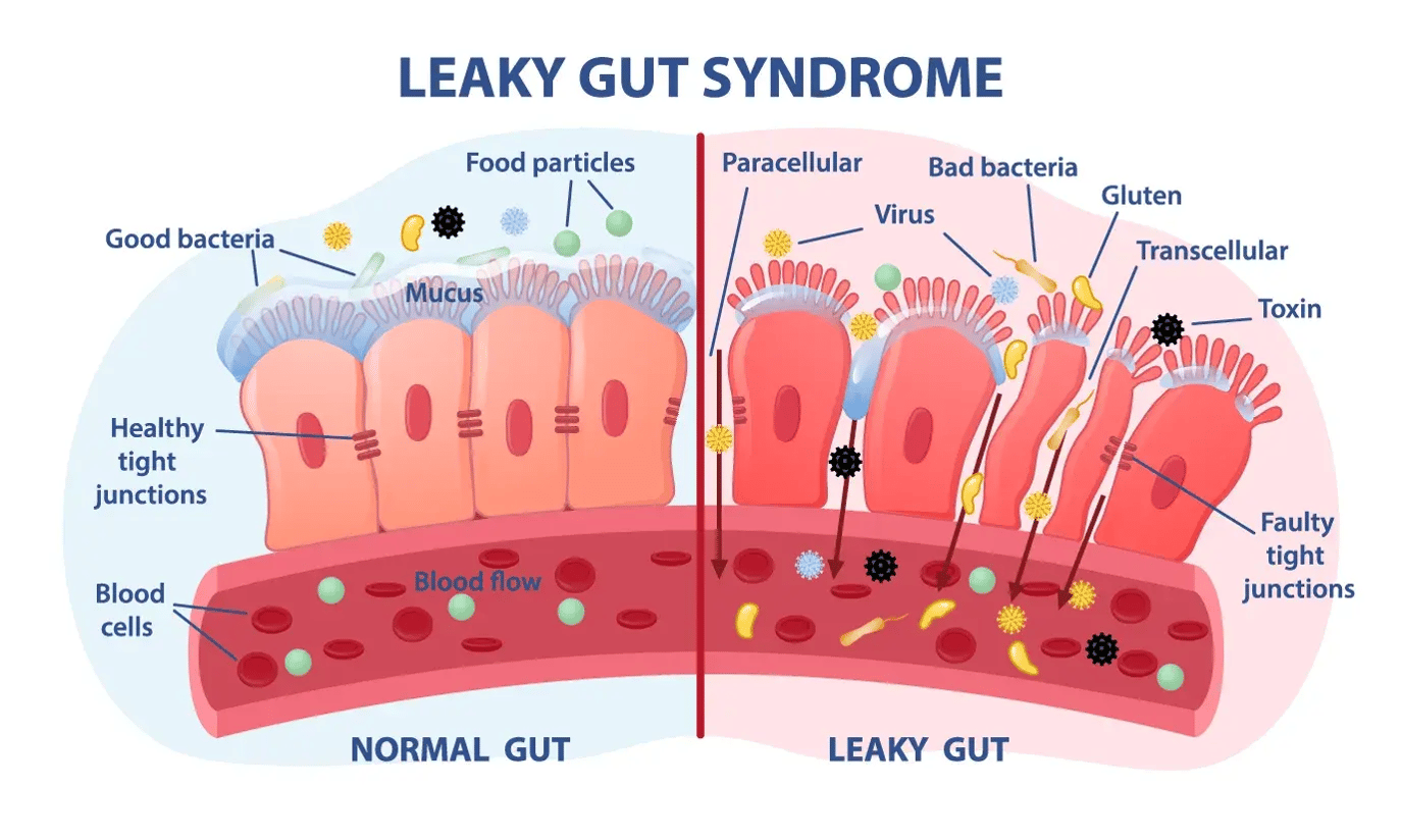 Leaky Gut Diagram